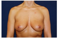 Breast Augmentation Before Photo by Michael Law, MD; Raleigh, NC - Case 33246