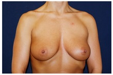 Breast Augmentation Before Photo by Michael Law, MD; Raleigh, NC - Case 33246