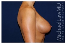Breast Augmentation After Photo by Michael Law, MD; Raleigh, NC - Case 33246