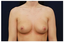 Breast Augmentation Before Photo by Michael Law, MD; Raleigh, NC - Case 33247