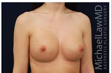 Breast Augmentation After Photo by Michael Law, MD; Raleigh, NC - Case 33247
