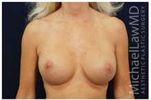 Breast Augmentation After Photo by Michael Law, MD; Raleigh, NC - Case 33249