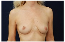 Breast Augmentation Before Photo by Michael Law, MD; Raleigh, NC - Case 33249