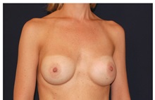 Breast Augmentation After Photo by Michael Law, MD; Raleigh, NC - Case 33257