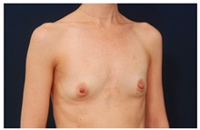 Breast Augmentation Before Photo by Michael Law, MD; Raleigh, NC - Case 33257