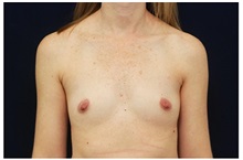 Breast Augmentation Before Photo by Michael Law, MD; Raleigh, NC - Case 33260