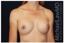 Breast Augmentation After Photo by Michael Law, MD; Raleigh, NC - Case 33260