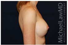 Breast Augmentation After Photo by Michael Law, MD; Raleigh, NC - Case 33260