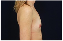 Breast Augmentation Before Photo by Michael Law, MD; Raleigh, NC - Case 33260