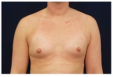 Breast Augmentation Before Photo by Michael Law, MD; Raleigh, NC - Case 33261