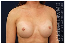 Breast Augmentation After Photo by Michael Law, MD; Raleigh, NC - Case 33261