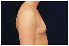 Breast Augmentation Before Photo by Michael Law, MD; Raleigh, NC - Case 33261