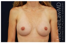 Breast Augmentation After Photo by Michael Law, MD; Raleigh, NC - Case 33262