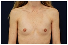 Breast Augmentation Before Photo by Michael Law, MD; Raleigh, NC - Case 33262