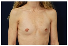 Breast Augmentation Before Photo by Michael Law, MD; Raleigh, NC - Case 33262
