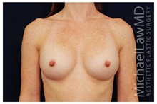 Breast Augmentation After Photo by Michael Law, MD; Raleigh, NC - Case 33263