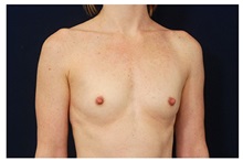 Breast Augmentation Before Photo by Michael Law, MD; Raleigh, NC - Case 33263