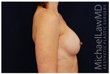 Breast Augmentation After Photo by Michael Law, MD; Raleigh, NC - Case 33263