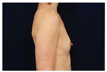 Breast Augmentation Before Photo by Michael Law, MD; Raleigh, NC - Case 33263