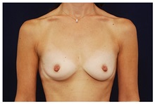 Breast Augmentation Before Photo by Michael Law, MD; Raleigh, NC - Case 33265
