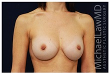 Breast Augmentation After Photo by Michael Law, MD; Raleigh, NC - Case 33265