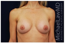 Breast Augmentation After Photo by Michael Law, MD; Raleigh, NC - Case 33266