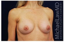 Breast Augmentation After Photo by Michael Law, MD; Raleigh, NC - Case 33266