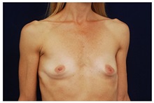 Breast Augmentation Before Photo by Michael Law, MD; Raleigh, NC - Case 33266
