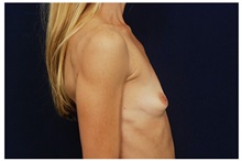 Breast Augmentation Before Photo by Michael Law, MD; Raleigh, NC - Case 33266