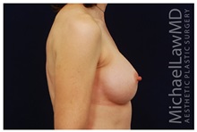 Breast Augmentation After Photo by Michael Law, MD; Raleigh, NC - Case 33270