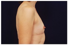 Breast Augmentation Before Photo by Michael Law, MD; Raleigh, NC - Case 33270