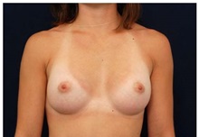 Breast Augmentation After Photo by Michael Law, MD; Raleigh, NC - Case 33272