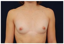 Breast Augmentation Before Photo by Michael Law, MD; Raleigh, NC - Case 33272