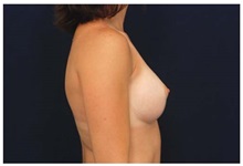 Breast Augmentation After Photo by Michael Law, MD; Raleigh, NC - Case 33272