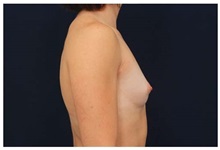 Breast Augmentation Before Photo by Michael Law, MD; Raleigh, NC - Case 33272