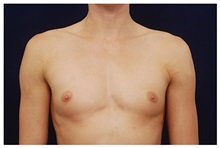 Breast Augmentation Before Photo by Michael Law, MD; Raleigh, NC - Case 33274