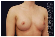 Breast Augmentation After Photo by Michael Law, MD; Raleigh, NC - Case 33274