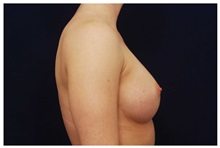 Breast Augmentation After Photo by Michael Law, MD; Raleigh, NC - Case 33274