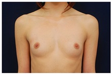 Breast Augmentation Before Photo by Michael Law, MD; Raleigh, NC - Case 33277