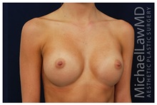 Breast Augmentation After Photo by Michael Law, MD; Raleigh, NC - Case 33277