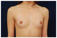 Breast Augmentation Before Photo by Michael Law, MD; Raleigh, NC - Case 33277
