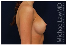 Breast Augmentation After Photo by Michael Law, MD; Raleigh, NC - Case 33277