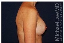 Breast Augmentation After Photo by Michael Law, MD; Raleigh, NC - Case 33279