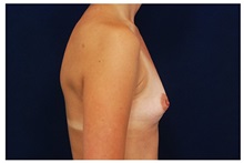 Breast Augmentation Before Photo by Michael Law, MD; Raleigh, NC - Case 33279