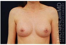 Breast Augmentation After Photo by Michael Law, MD; Raleigh, NC - Case 33280