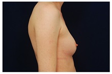 Breast Augmentation Before Photo by Michael Law, MD; Raleigh, NC - Case 33280