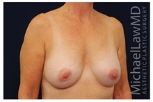 Breast Augmentation After Photo by Michael Law, MD; Raleigh, NC - Case 33282