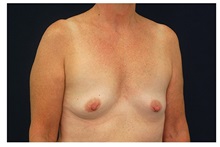 Breast Augmentation Before Photo by Michael Law, MD; Raleigh, NC - Case 33282