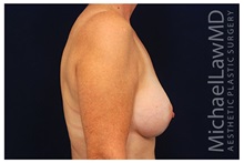 Breast Augmentation After Photo by Michael Law, MD; Raleigh, NC - Case 33282