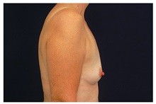 Breast Augmentation Before Photo by Michael Law, MD; Raleigh, NC - Case 33282